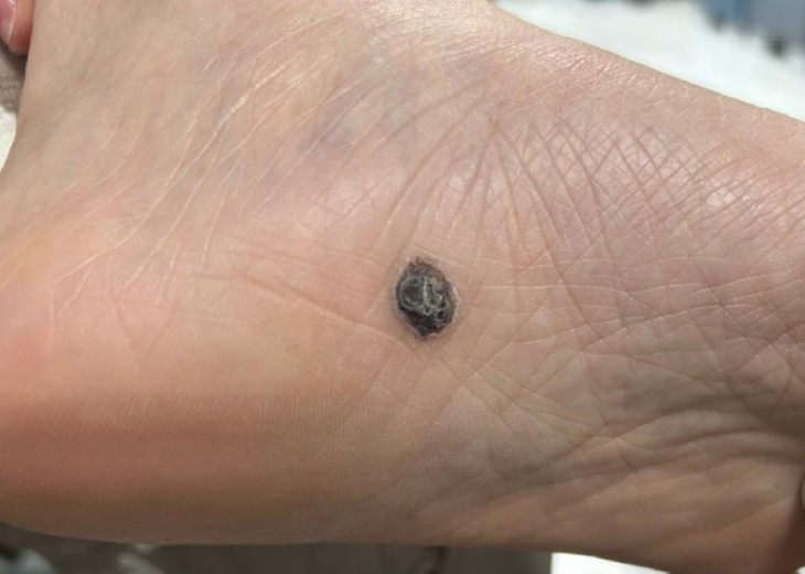 Nốt ruồi dưới lòng bàn chân trái của bệnh nhân với nhiều điểm bất thường - Ảnh: Bệnh viện cung cấp